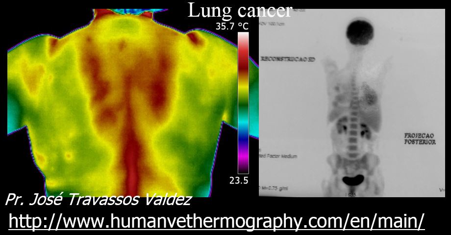 X-ray and thermography of lung cancer medical condition
