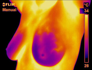 Image thermique d'un sein en dépistage du cancer
