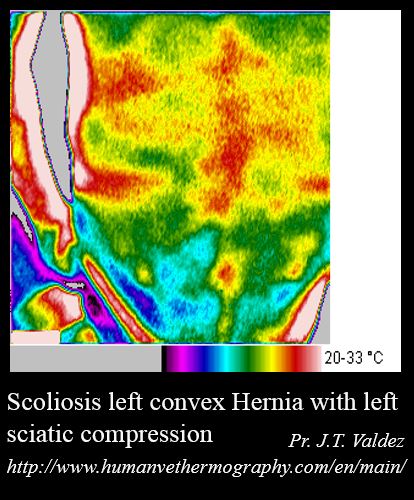 View in thermography of a scoliosis left convex hernia with left sciatic compression