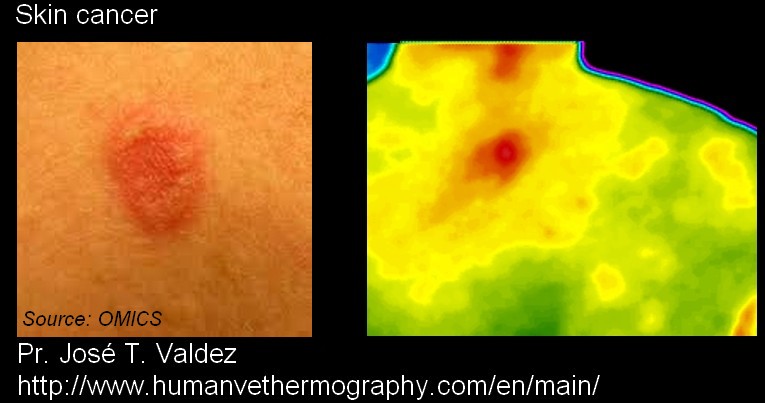 Thermographic infrared view of a skin cancer with digital view