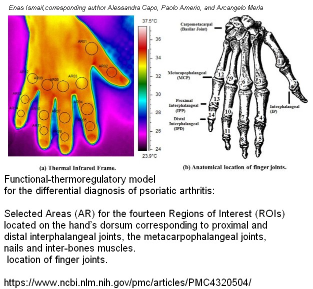 imagerie thermique d'une arthritis psoriasis