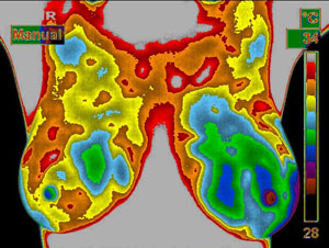 Thermische beeld van een borst's kanker