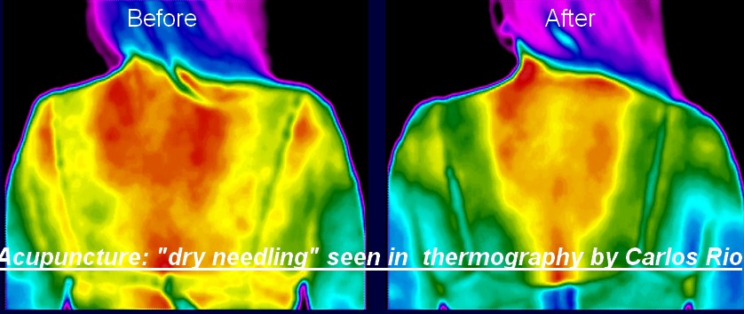 Dry needling treatment monitored with thermography
