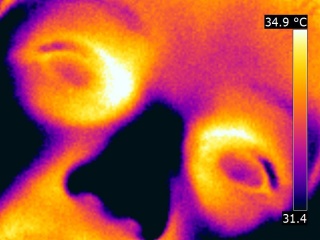 Thermographie de deux yeux d'un corps humain