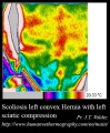 Scoliosis-thermography.jpg