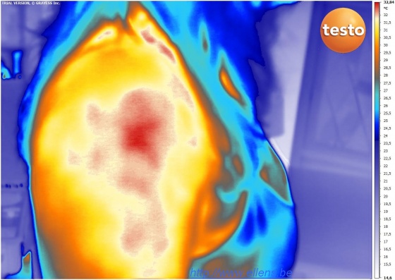 Thermographie en imagerie thermique infrarouge d'une épaule en inflammation