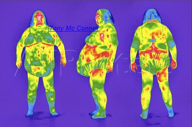Obésité en thermographie, Image Tony Mc Donnell, http://www.allposters.com/-sp/Obese-Woman-Thermogram-Posters_i10037843_.htm