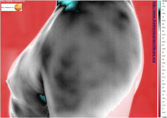Image thermique infrarouge d'une épaule humaine masculine sans pathologie