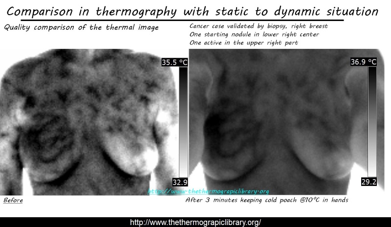 Observation of a dynamic thermographic protocol on a breastg cancer