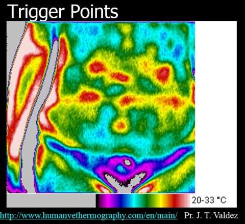 Imagerie thermique de trigger points, points de gâchette