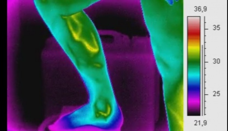 Thermography of a calf with varicose ceins