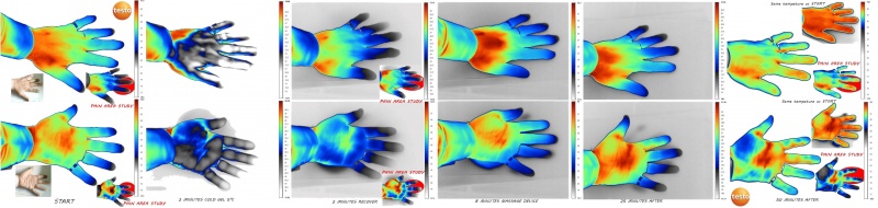 "Thermography of a hand under stimulation