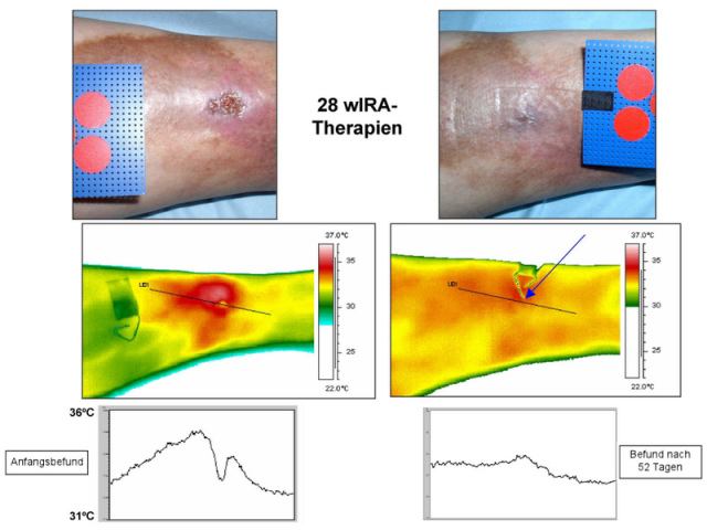 Thermographie d'un suivi de traitement de guérison du genou