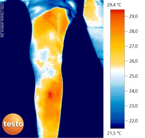 Thermographie d'un genou après opération par Philippe Sterkendries