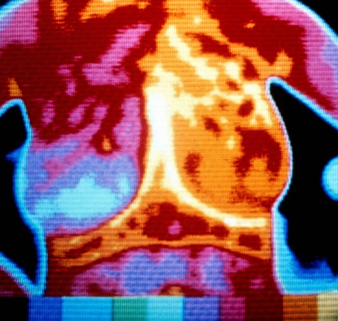 Image thermique d'un sein souffrant d'un cancer, examen en thermographie infrarouge, credits: Wellcome Collection