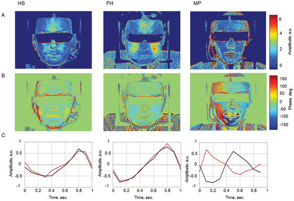 Thermografie van 3 mensen over migraine. Source: PLOS one, authors: Nina Zaproudina, Victor Teplov, Ervin Nippolainen, Jukka A. Lipponen, Alexei A. Kamshilin, Matti Närhi, Pasi A. Karjalainen, Rashid Giniatullin
