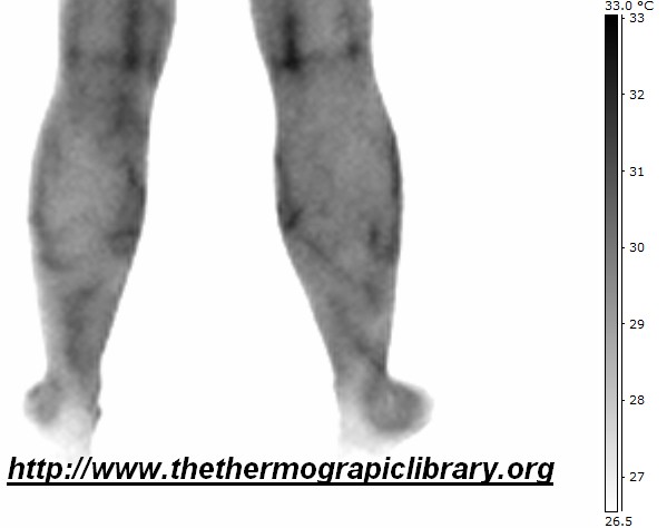 Fichier:Varicosites-thermographie-medicale.jpg