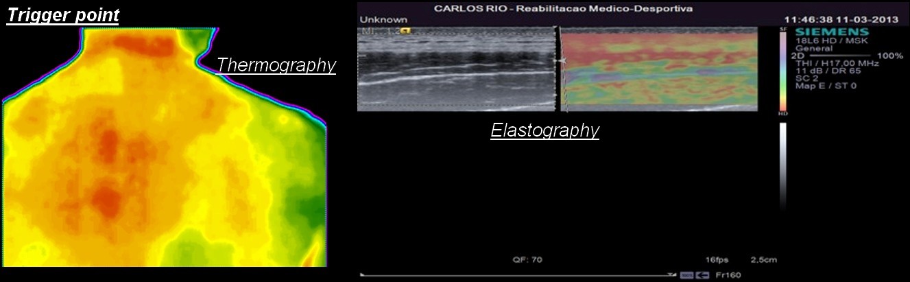 Élastographie et thermographie pour le diagnostic du trigger point