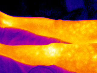 Thermographie d'une phlébite des jambes