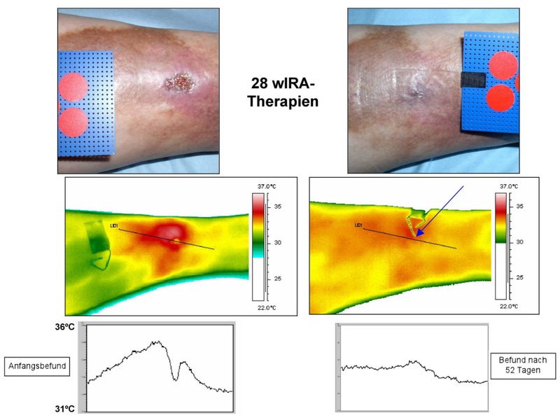 Thermographie d'un suivi de traitement de guérison du genou