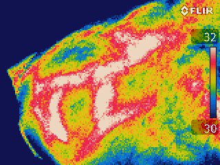 Thermographie d'un genou enflammé, corps humain