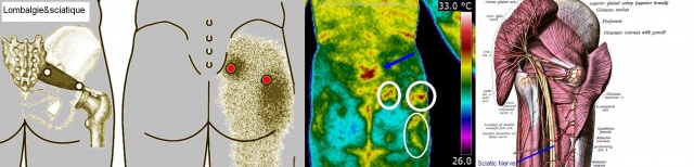 Sciatique vue en anatomies et en thermographie