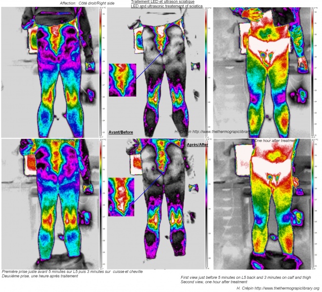 Fichier:Sciatique-hernie-discale-thermographie-LED-ultrasons.jpg