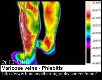 Thermographie d'une phlébite dans la jambe inférieure