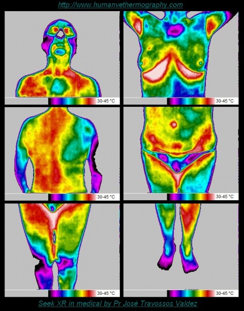 Exploitation en médical de la Seek thermal XR
