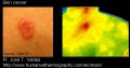 Skin-cancer-thermography-jose-valdez.jpg
