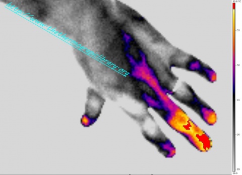 medical thermography of a paronychia of around 3 days