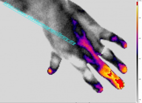 Thermographie d'un panaris stade 1 de 3 jours