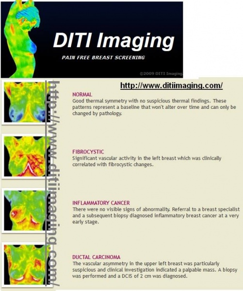 Fichier:Breast-cancer-thermography.jpg