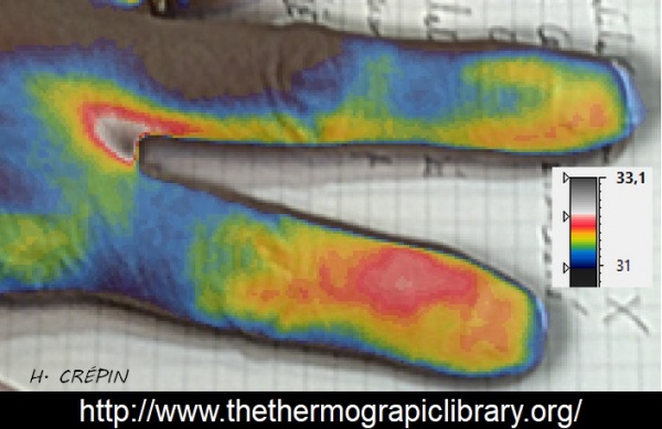 "Ténosynovite des doigts en thermographie"