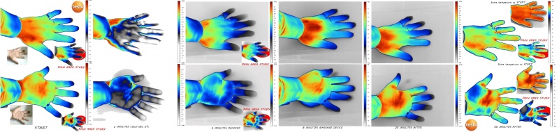 "Thermographie d'une main sous stimulation"