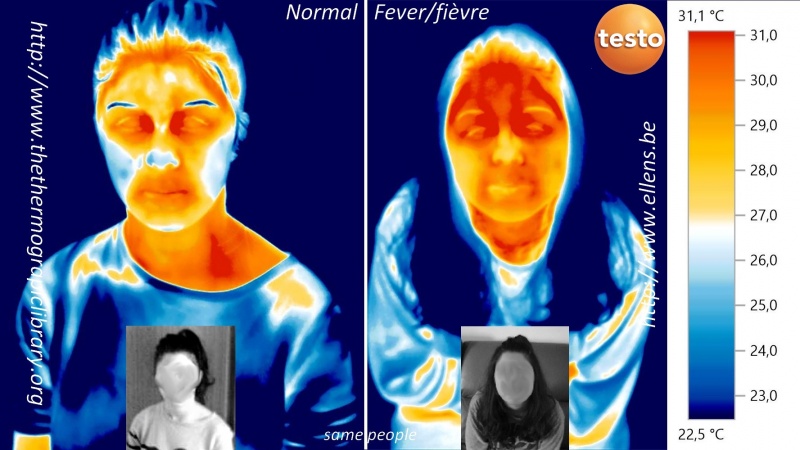 Fichier:Head-thermography-fever-comparison.jpg