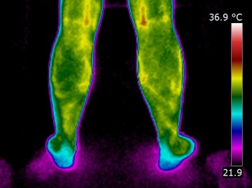 Image thermique infrarouge de mollets atteints de varicosités