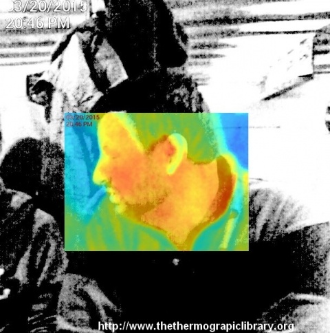 Personne vue en thermographie et fusion dans l'image par une Seek thermal