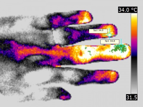 medical thermography of a paronychia of around 2 days